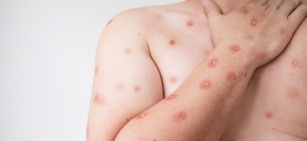 Casos de mpox em Minas